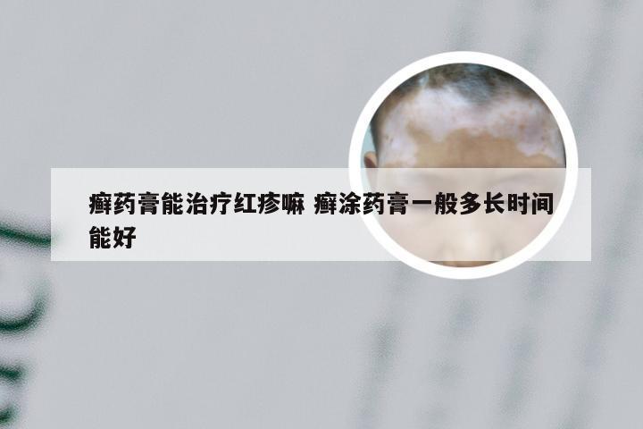 癣药膏能治疗红疹嘛 癣涂药膏一般多长时间能好