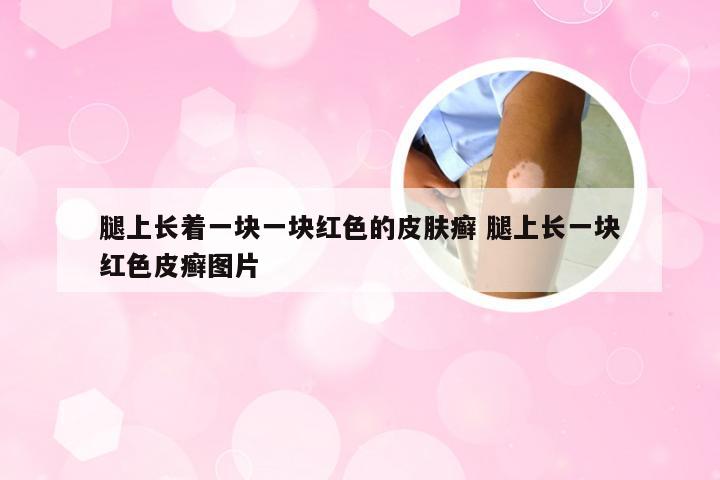 腿上长着一块一块红色的皮肤癣 腿上长一块红色皮癣图片