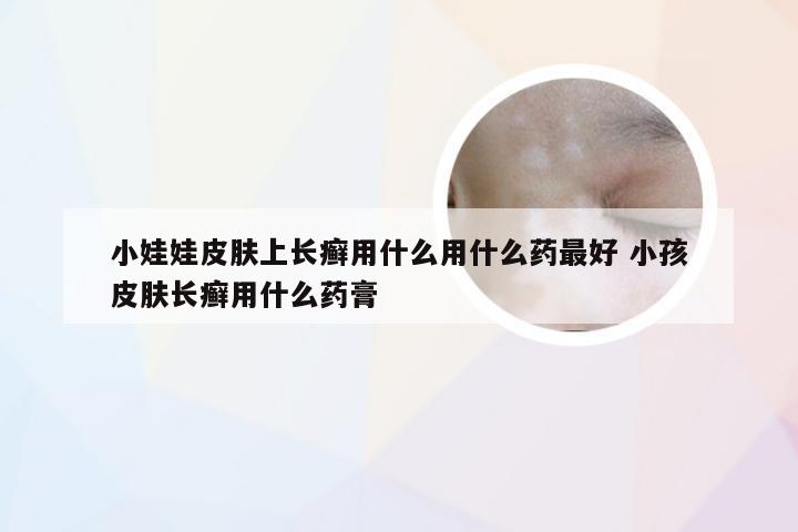 小娃娃皮肤上长癣用什么用什么药最好 小孩皮肤长癣用什么药膏