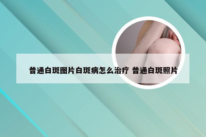 普通白斑图片白斑病怎么治疗 普通白斑照片