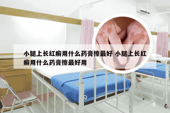 小腿上长红癣用什么药膏擦最好 小腿上长红癣用什么药膏擦最好用
