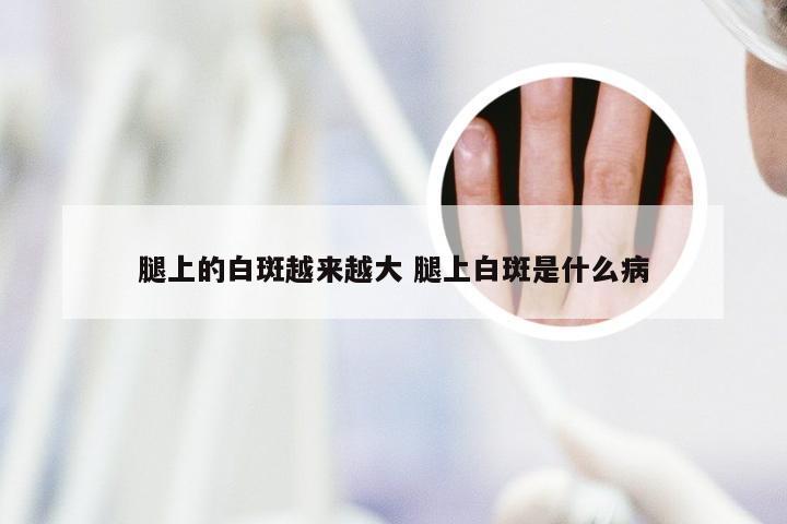 腿上的白斑越来越大 腿上白斑是什么病