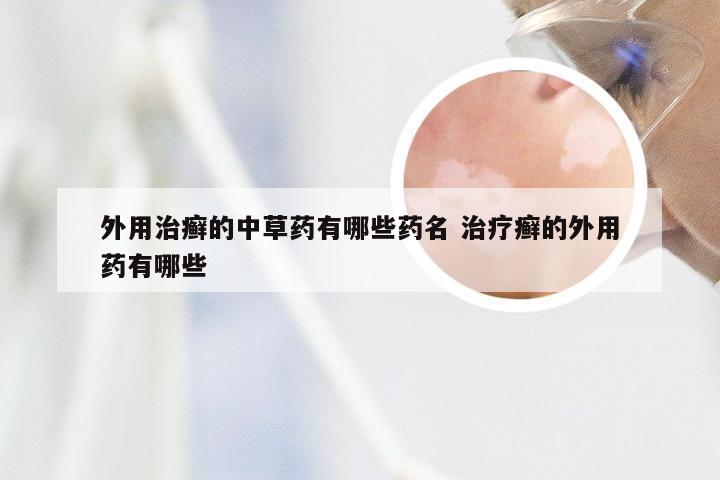 外用治癣的中草药有哪些药名 治疗癣的外用药有哪些