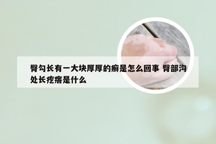 臀勾长有一大块厚厚的癣是怎么回事 臀部沟处长疙瘩是什么