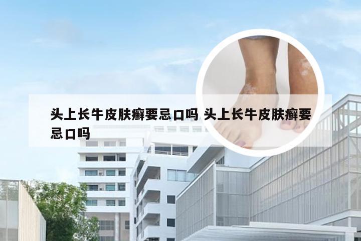 头上长牛皮肤癣要忌口吗 头上长牛皮肤癣要忌口吗
