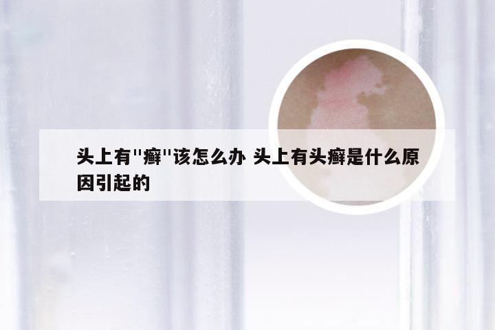 头上有"癣"该怎么办 头上有头癣是什么原因引起的