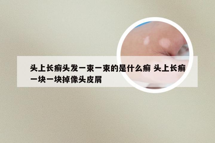 头上长癣头发一束一束的是什么癣 头上长癣一块一块掉像头皮屑