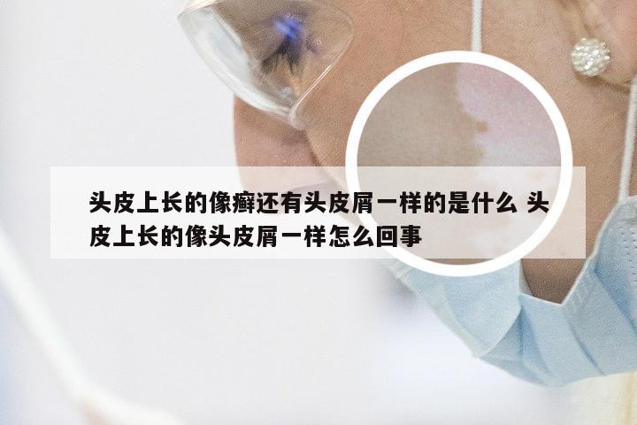 头皮上长的像癣还有头皮屑一样的是什么 头皮上长的像头皮屑一样怎么回事