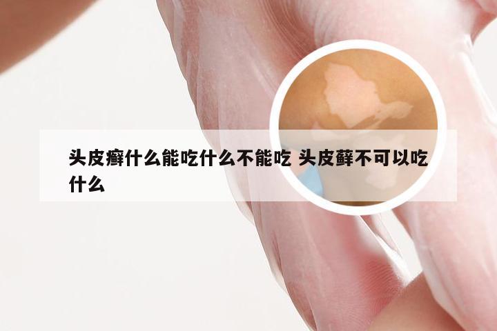 头皮癣什么能吃什么不能吃 头皮藓不可以吃什么
