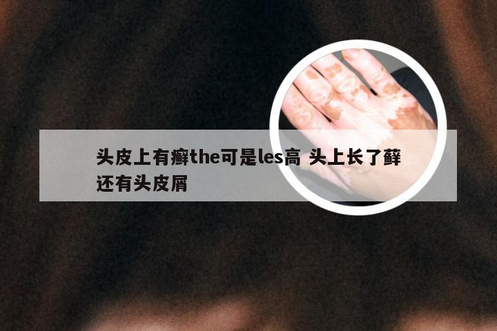 头皮上有癣the可是les高 头上长了藓还有头皮屑