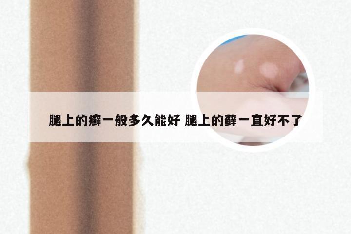 腿上的癣一般多久能好 腿上的藓一直好不了