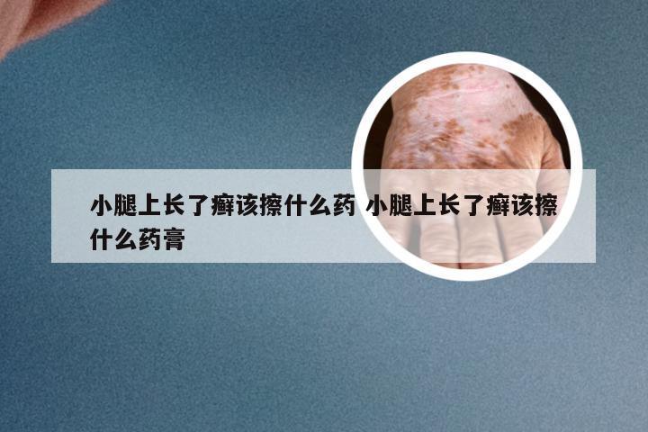 小腿上长了癣该擦什么药 小腿上长了癣该擦什么药膏