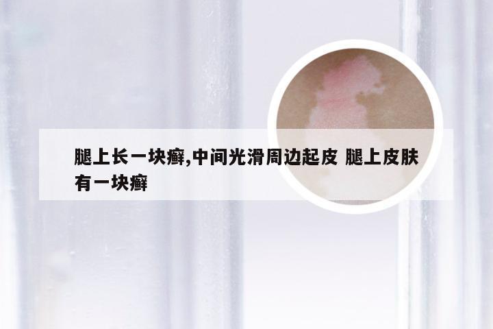 腿上长一块癣,中间光滑周边起皮 腿上皮肤有一块癣