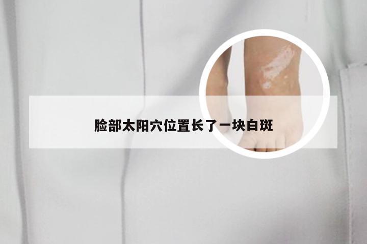 脸部太阳穴位置长了一块白斑