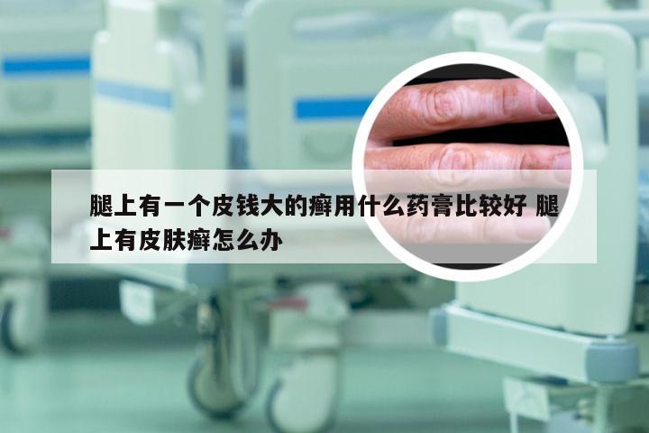 腿上有一个皮钱大的癣用什么药膏比较好 腿上有皮肤癣怎么办