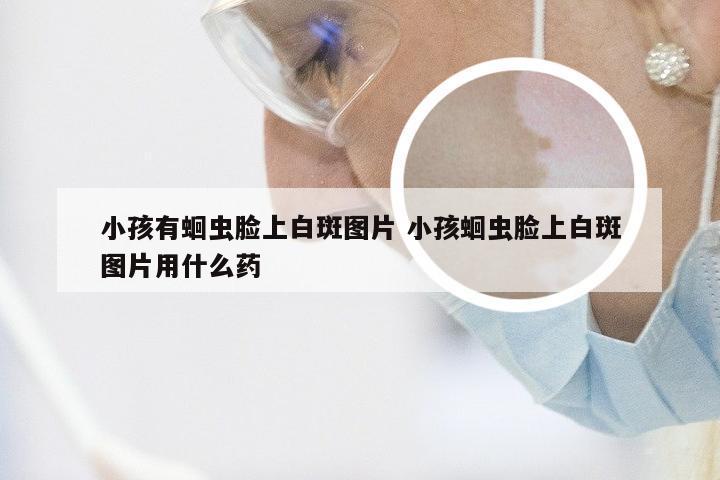 小孩有蛔虫脸上白斑图片 小孩蛔虫脸上白斑图片用什么药