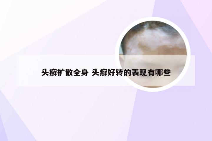 头癣扩散全身 头癣好转的表现有哪些
