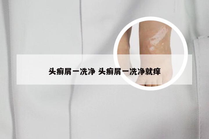 头癣屑一冼净 头癣屑一冼净就痒