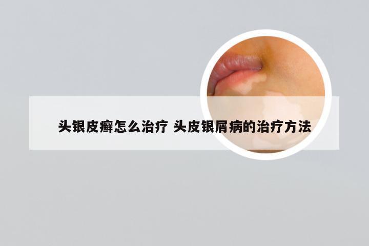 头银皮癣怎么治疗 头皮银屑病的治疗方法