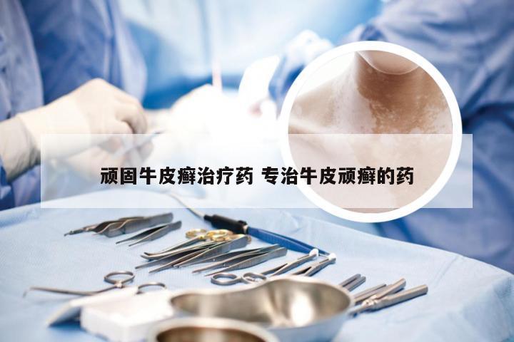 顽固牛皮癣治疗药 专治牛皮顽癣的药