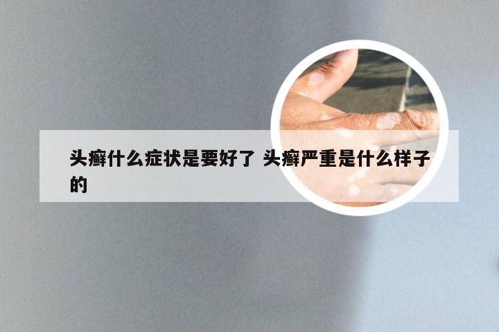 头癣什么症状是要好了 头癣严重是什么样子的