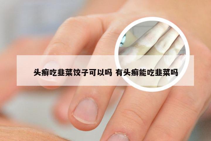 头癣吃韭菜饺子可以吗 有头癣能吃韭菜吗
