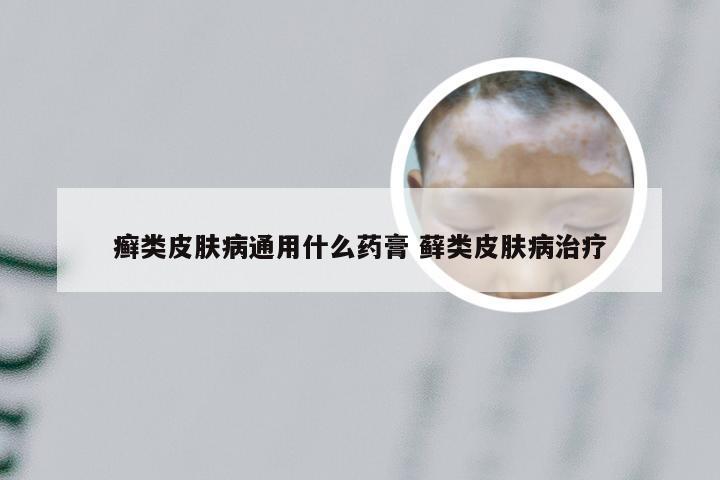 癣类皮肤病通用什么药膏 藓类皮肤病治疗