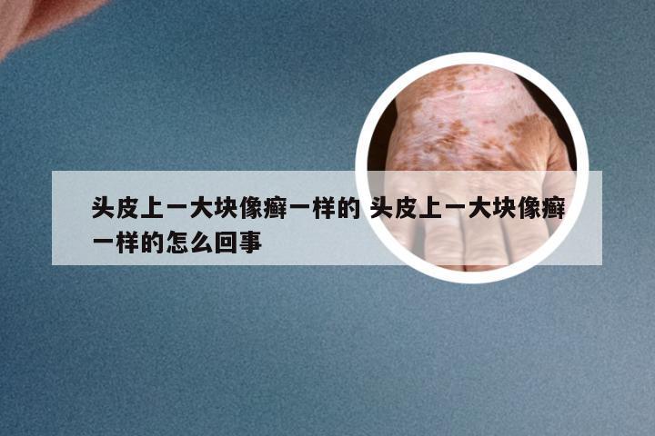 头皮上一大块像癣一样的 头皮上一大块像癣一样的怎么回事