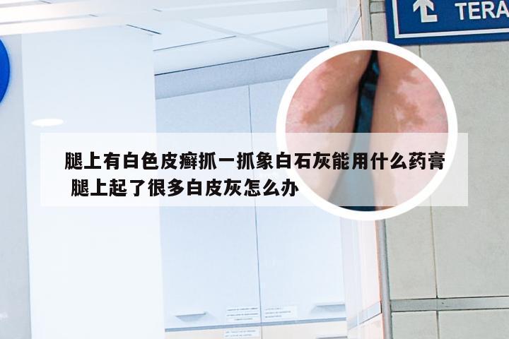 腿上有白色皮癣抓一抓象白石灰能用什么药膏 腿上起了很多白皮灰怎么办
