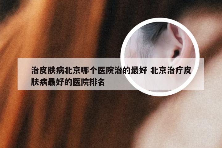 治皮肤病北京哪个医院治的最好 北京治疗皮肤病最好的医院排名