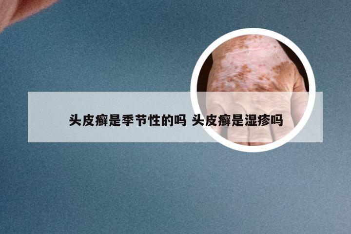 头皮癣是季节性的吗 头皮癣是湿疹吗