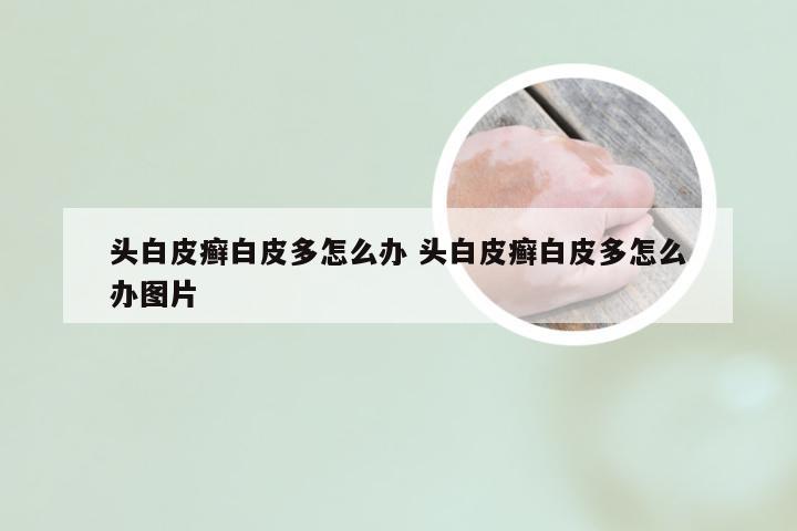 头白皮癣白皮多怎么办 头白皮癣白皮多怎么办图片