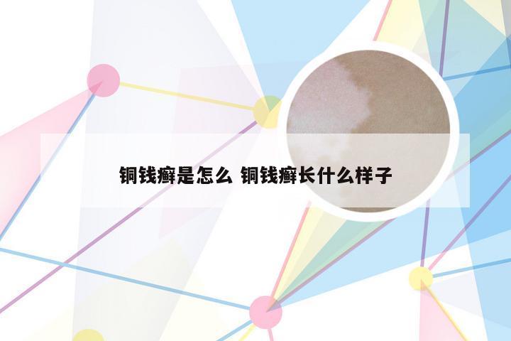铜钱癣是怎么 铜钱癣长什么样子
