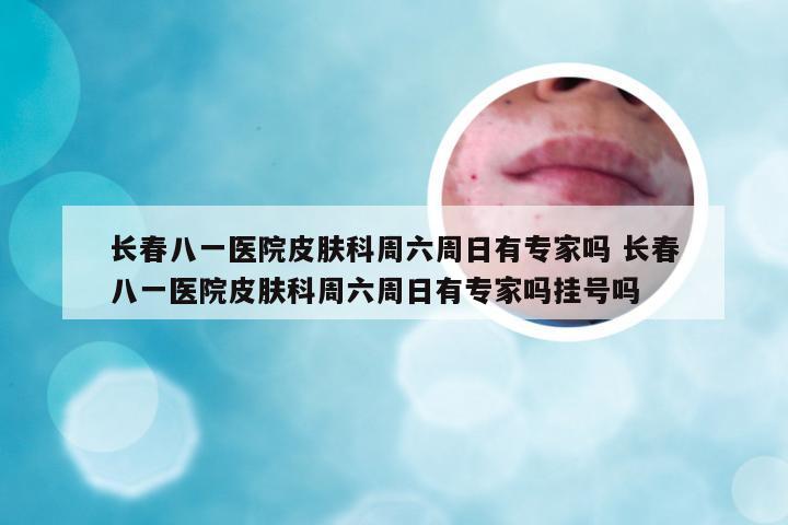 长春八一医院皮肤科周六周日有专家吗 长春八一医院皮肤科周六周日有专家吗挂号吗