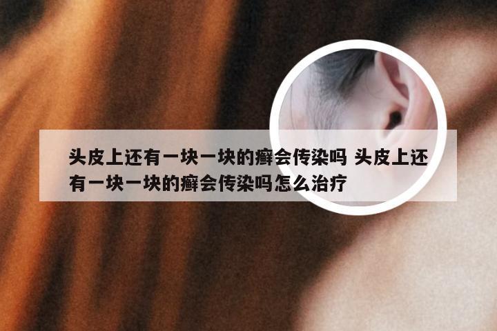 头皮上还有一块一块的癣会传染吗 头皮上还有一块一块的癣会传染吗怎么治疗