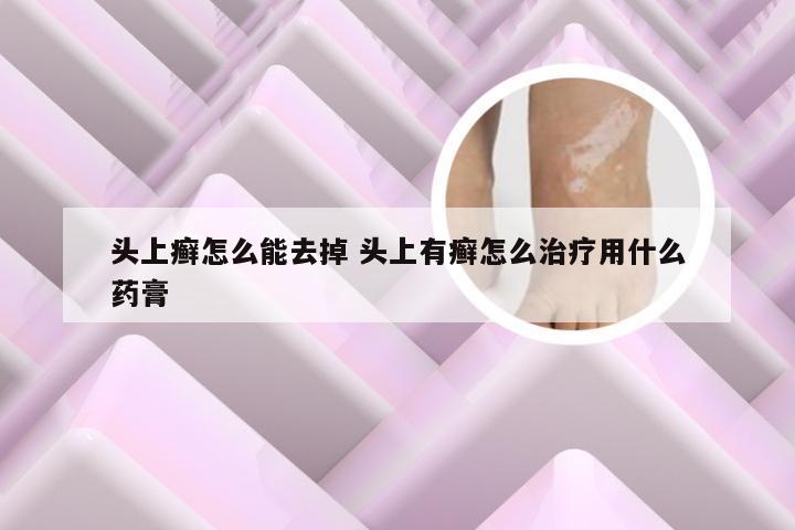头上癣怎么能去掉 头上有癣怎么治疗用什么药膏