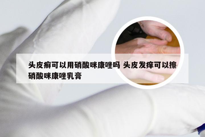 头皮癣可以用硝酸咪康唑吗 头皮发痒可以擦硝酸咪康唑乳膏