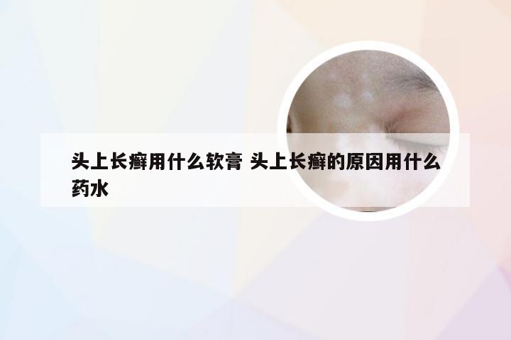 头上长癣用什么软膏 头上长癣的原因用什么药水