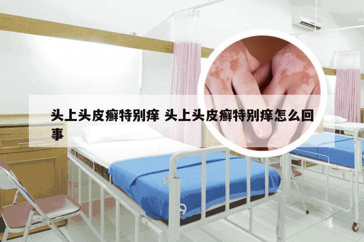 头上头皮癣特别痒 头上头皮癣特别痒怎么回事