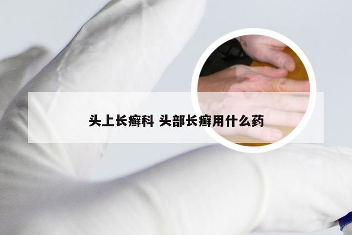 头上长癣科 头部长癣用什么药