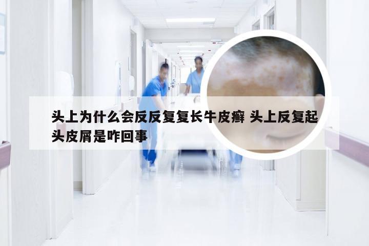头上为什么会反反复复长牛皮癣 头上反复起头皮屑是咋回事