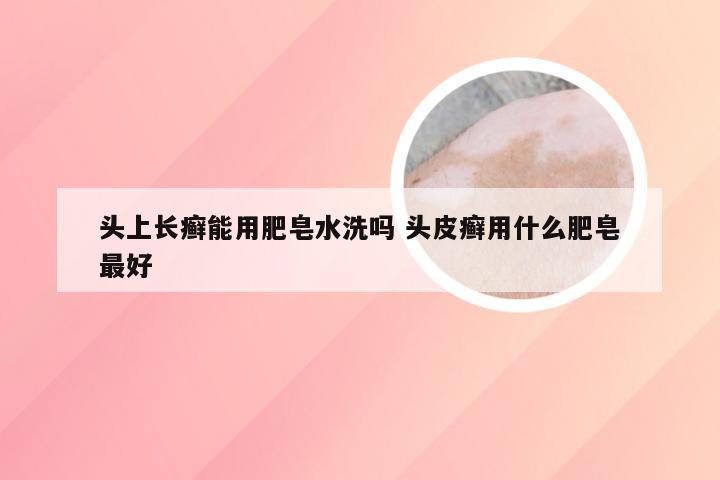 头上长癣能用肥皂水洗吗 头皮癣用什么肥皂最好