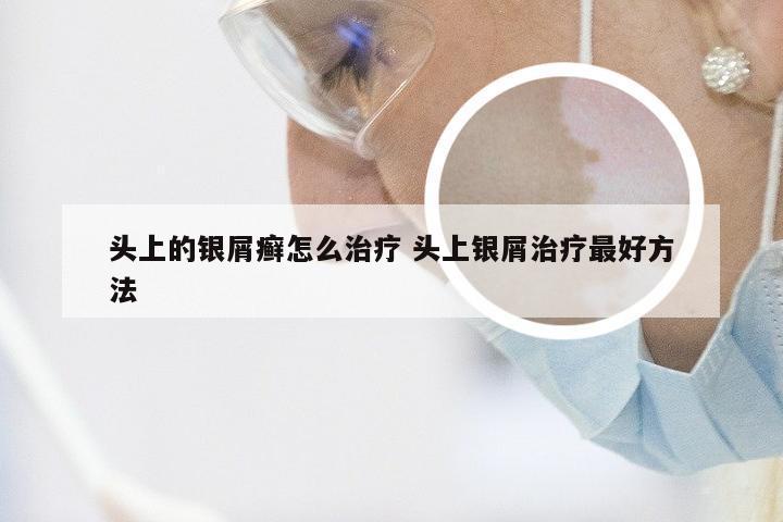 头上的银屑癣怎么治疗 头上银屑治疗最好方法