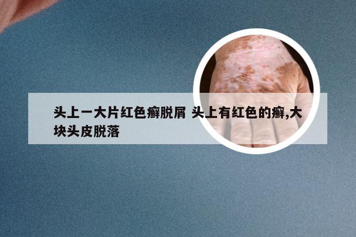 头上一大片红色癣脱屑 头上有红色的癣,大块头皮脱落