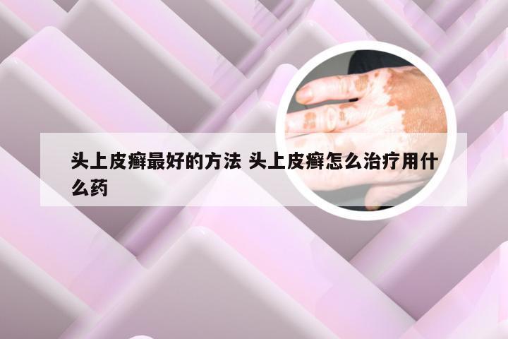 头上皮癣最好的方法 头上皮癣怎么治疗用什么药