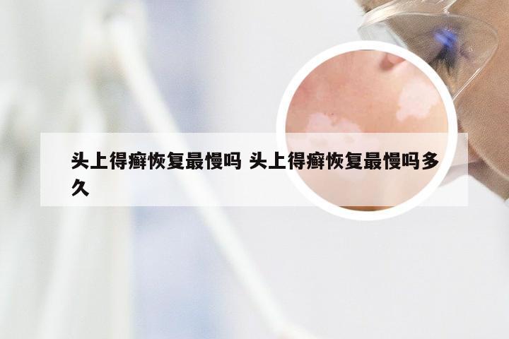 头上得癣恢复最慢吗 头上得癣恢复最慢吗多久