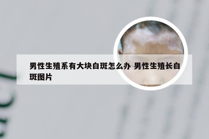 男性生殖系有大块白斑怎么办 男性生殖长白斑图片