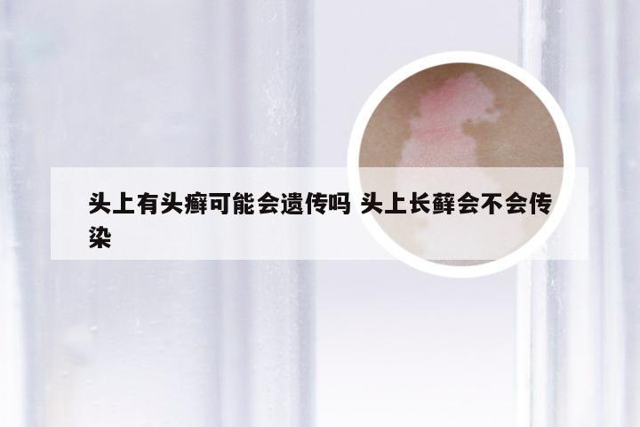 头上有头癣可能会遗传吗 头上长藓会不会传染