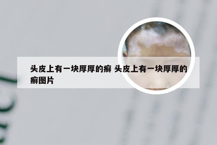 头皮上有一块厚厚的癣 头皮上有一块厚厚的癣图片