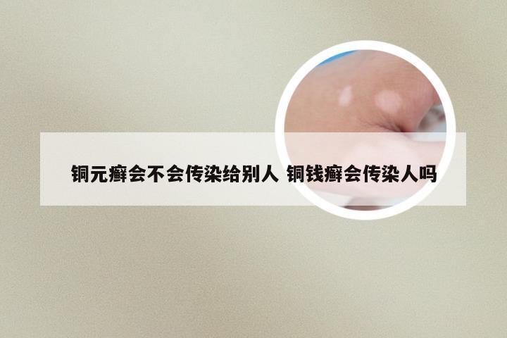 铜元癣会不会传染给别人 铜钱癣会传染人吗